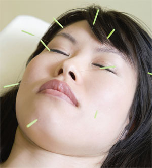 woman gettin acupunture in facial area
